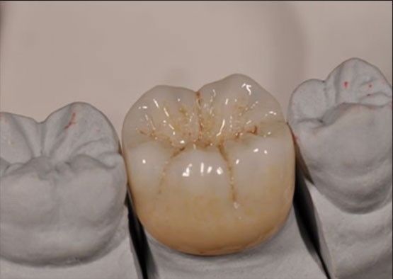높은 미적 Noritake Zirconia 자연 색상 안정적인 전체 Zirconia 왕관